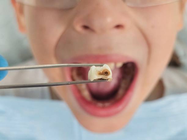 Best Emergency Root Canal Therapy in South Charleston, OH